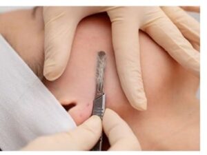 Dermaplaning